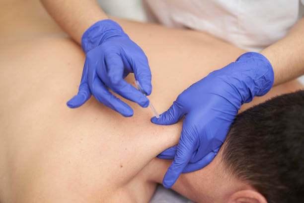 Dry needling treatment Brisbane — Rise Chiropractic & Wellness Albion